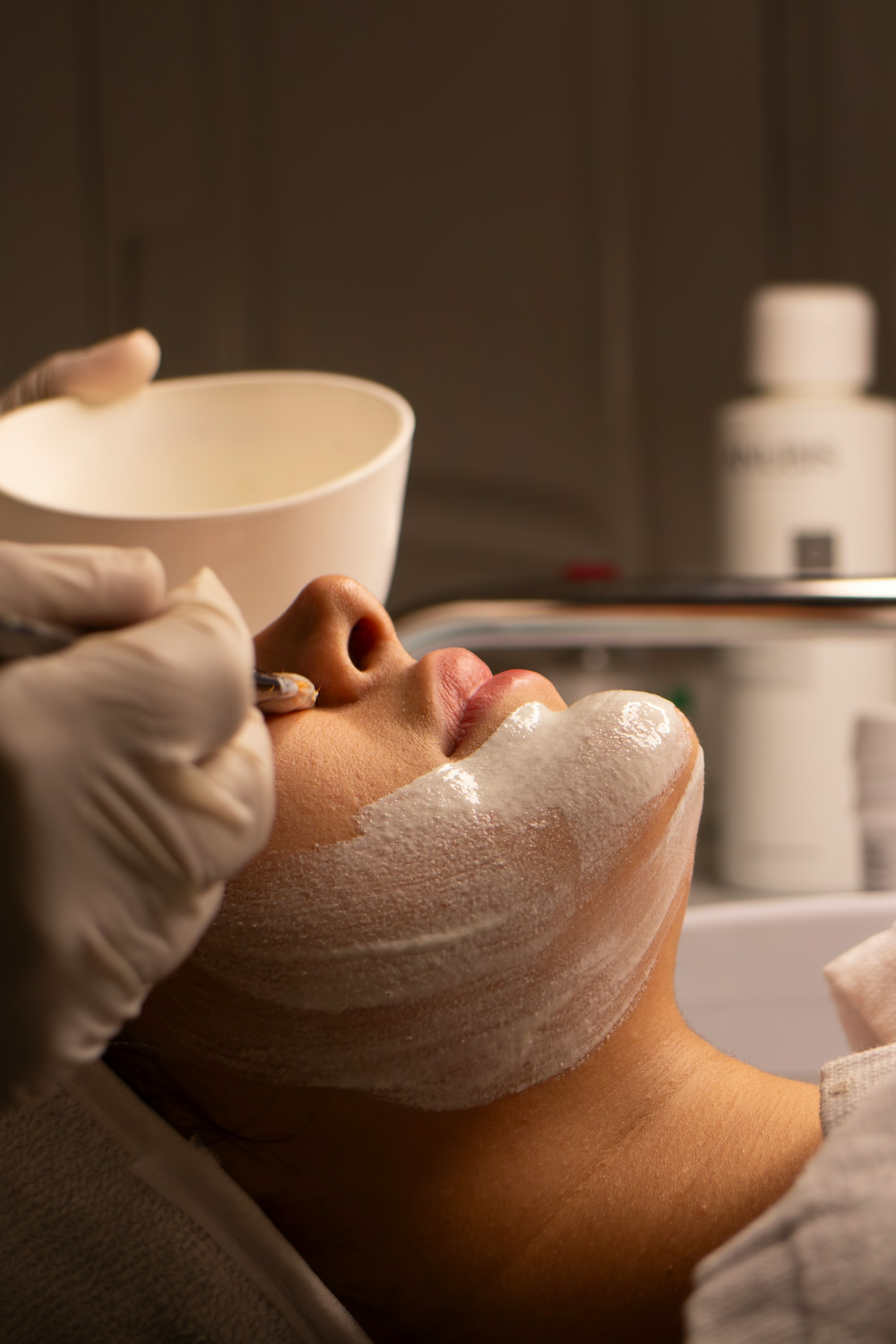 Hyaluronic acid filler, mid-face
